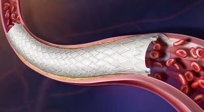 Revello Vascular Covered Stent - BD.com